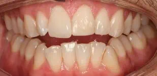 Close-up of teeth before treatment in Phoenix, AZ | 24th Street Dental Biltmore