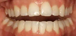 Close-up of teeth after treatment in Phoenix, AZ | 24th Street Dental Biltmore