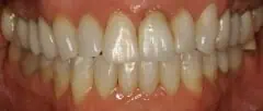 Close-up of teeth before treatment in Phoenix, AZ | 24th Street Dental Biltmore
