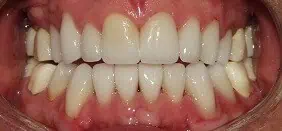 Close-up of teeth after treatment in Phoenix, AZ | 24th Street Dental Biltmore