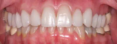 Close-up of teeth after treatment in Phoenix, AZ | 24th Street Dental Biltmore