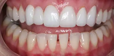 Close-up of teeth after treatment in Phoenix, AZ | 24th Street Dental Biltmore