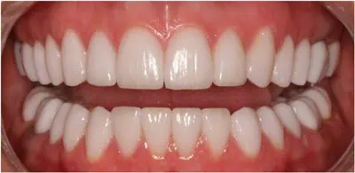 Close-up of teeth after treatment in Phoenix, AZ | 24th Street Dental Biltmore