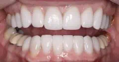 Close-up of teeth after treatment in Phoenix, AZ | 24th Street Dental Biltmore