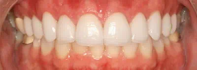 Natural teeth with mild stains in Phoenix, AZ | 24th Street Dental Biltmore