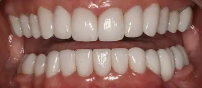 Evenly white teeth after whitening in Phoenix, AZ | 24th Street Dental Biltmore