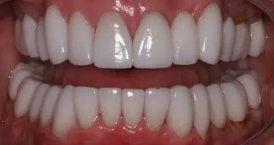 Perfectly aligned teeth with dental veneers in Phoenix, AZ | 24th Street Dental Biltmore