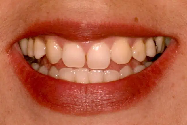 Close-up of teeth before treatment in Phoenix, AZ | 24th Street Dental Biltmore
