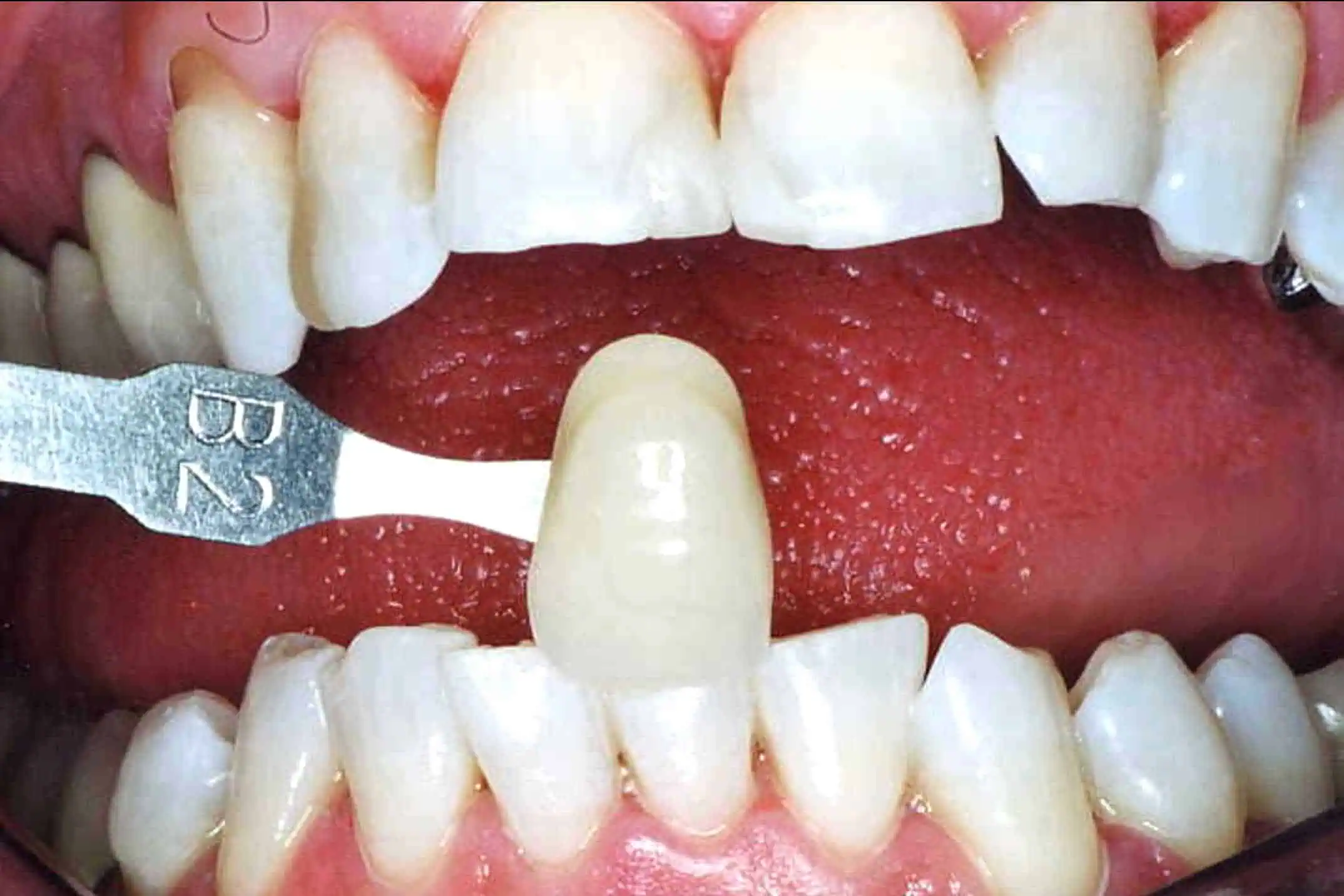 Tooth shade match after crown in Phoenix, AZ | 24th Street Dental Biltmore