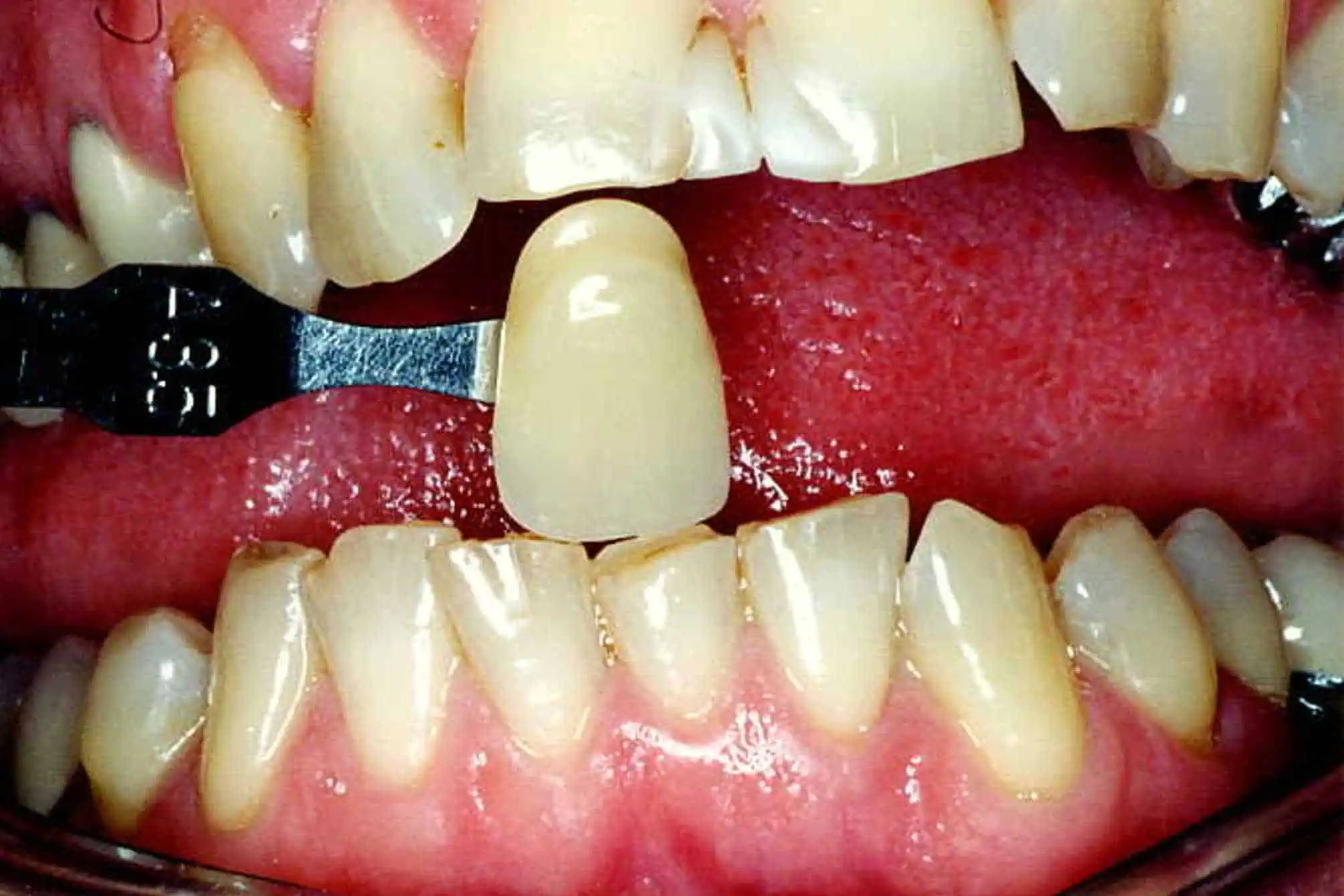 Tooth shade match before crown in Phoenix, AZ | 24th Street Dental Biltmore