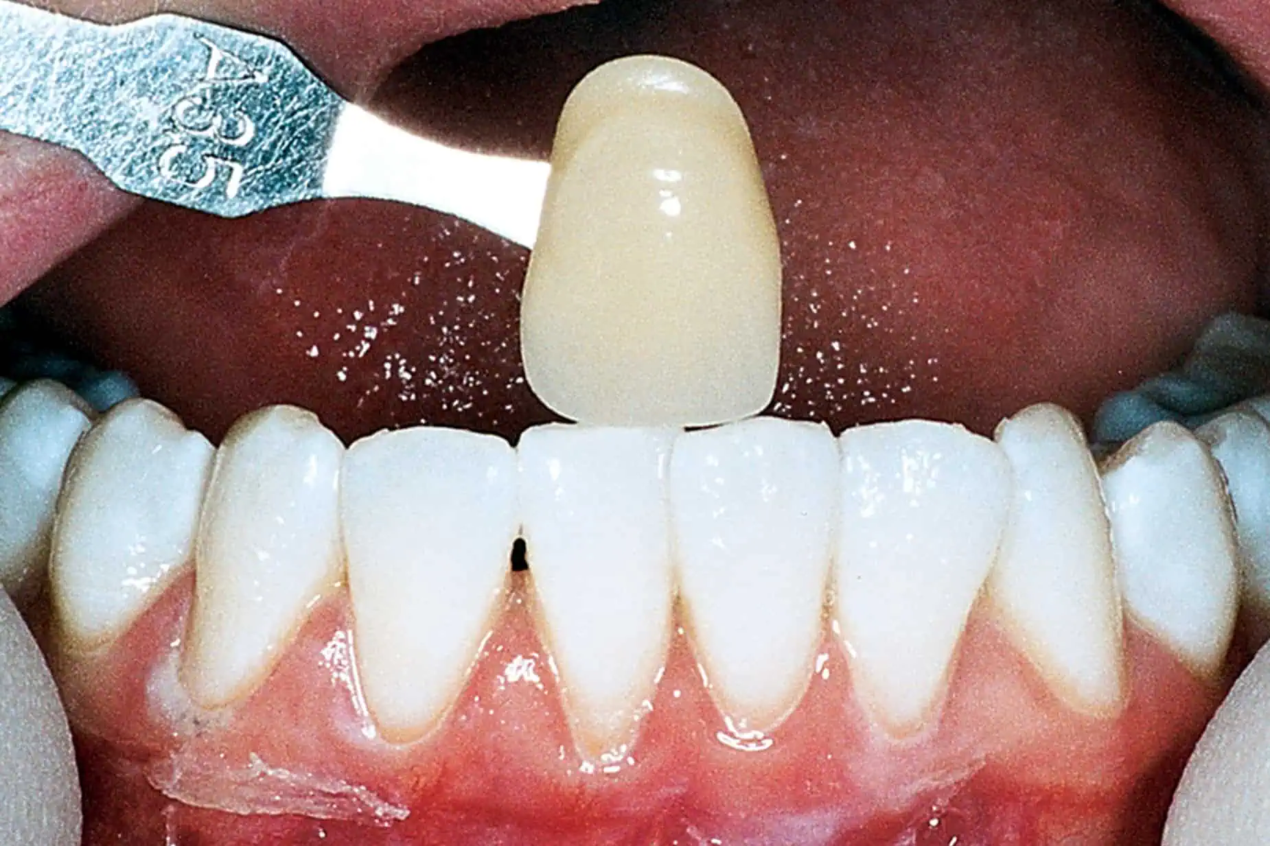 Tooth shade match after crown in Phoenix, AZ | 24th Street Dental Biltmore