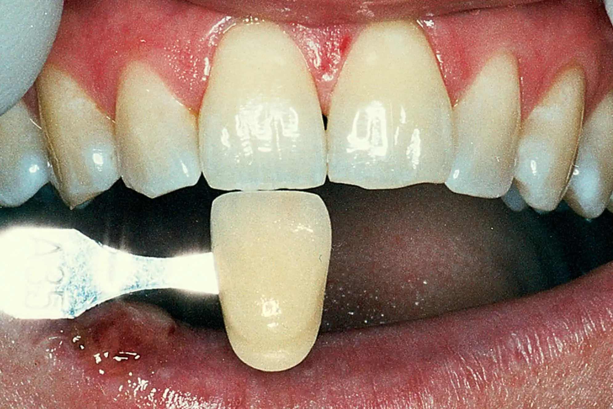 Tooth shade match before crown in Phoenix, AZ | 24th Street Dental Biltmore