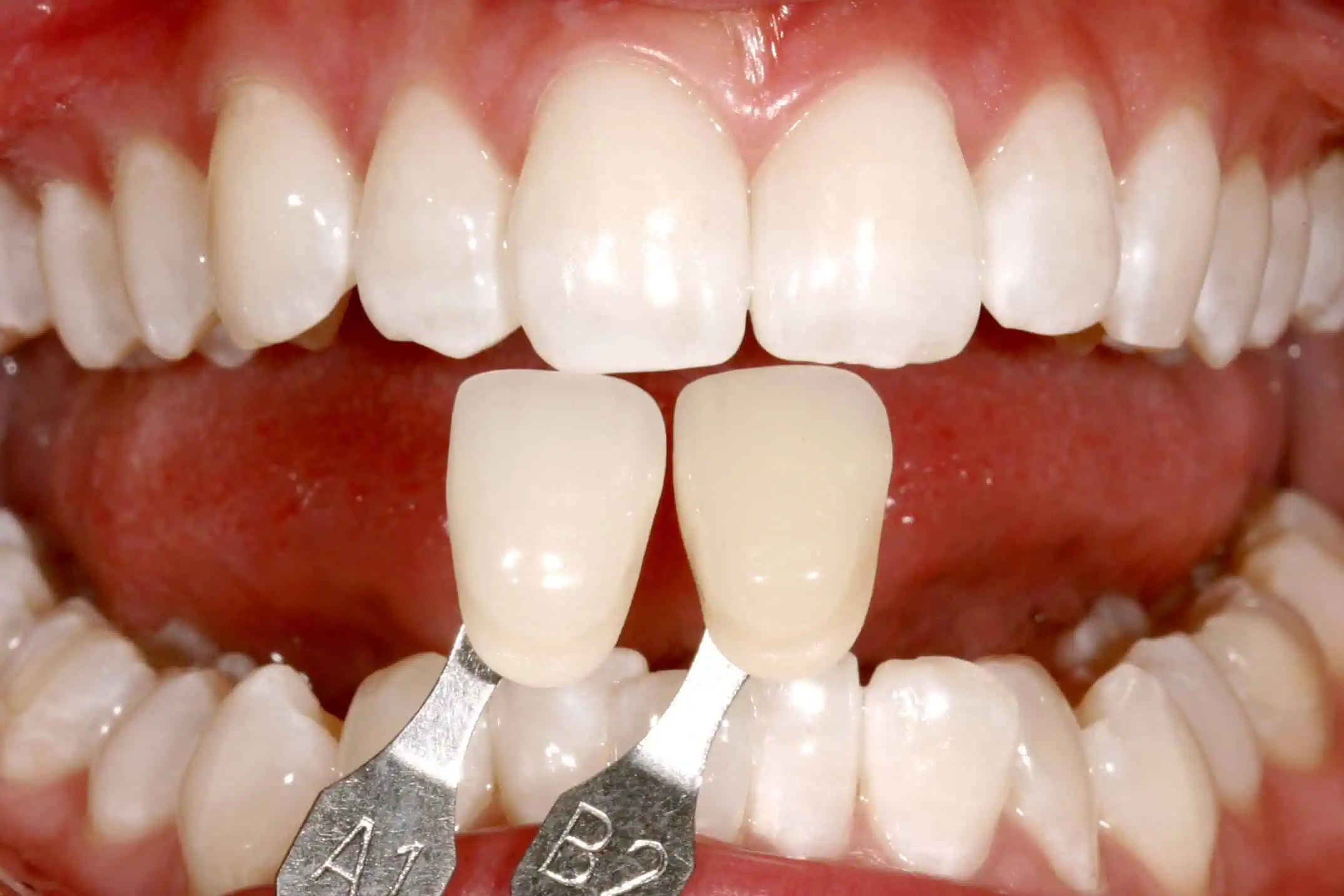 Tooth shade match after crown in Phoenix, AZ | 24th Street Dental Biltmore