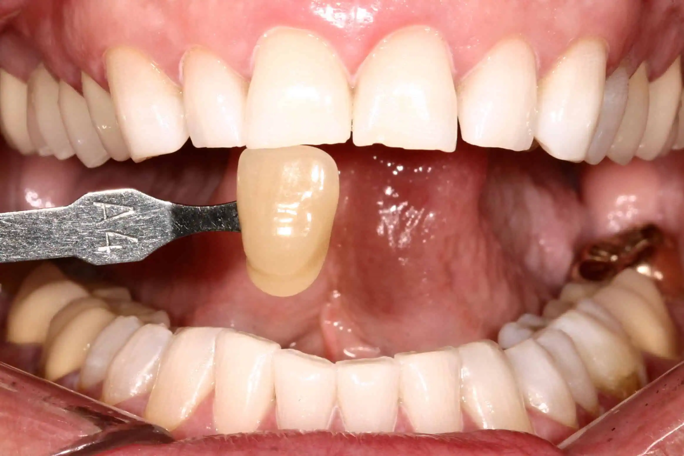 Tooth shade match after crown in Phoenix, AZ | 24th Street Dental Biltmore
