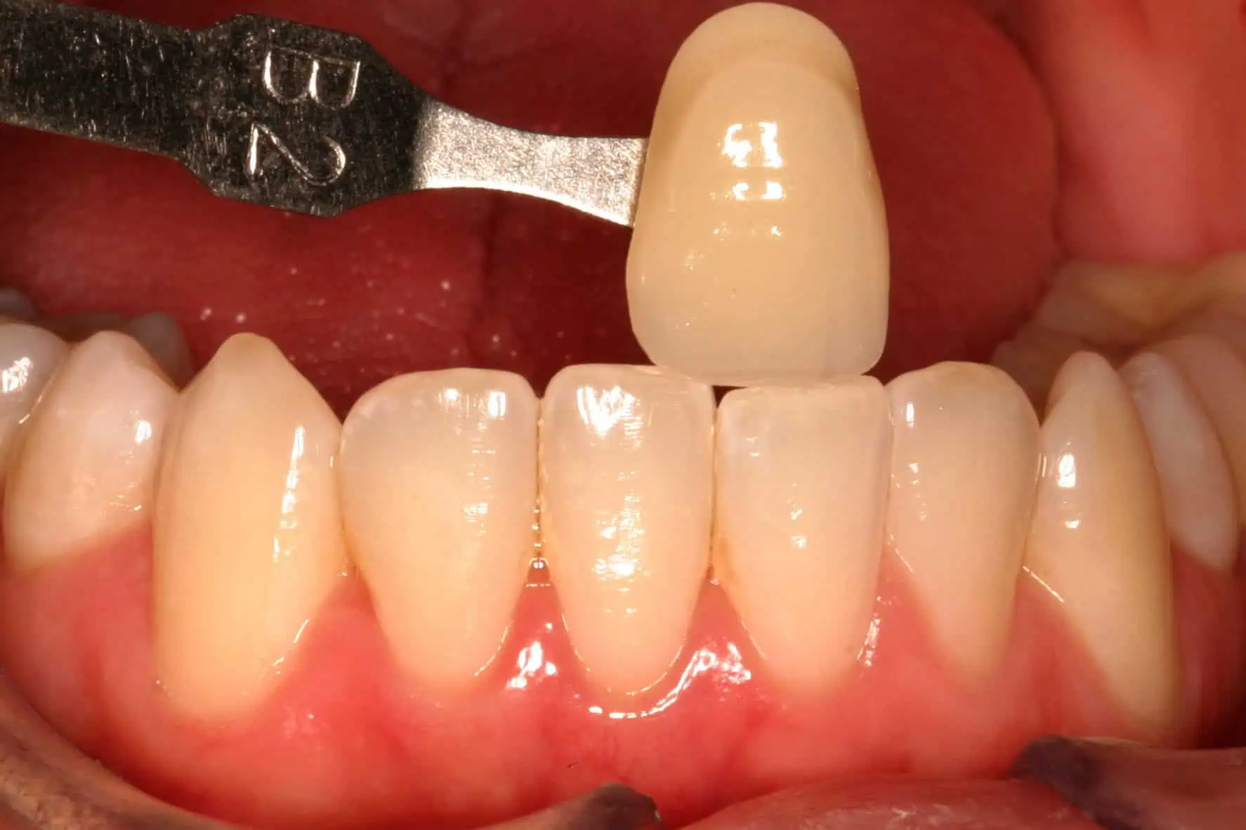 Tooth shade match crown in Phoenix, AZ | 24th Street Dental Biltmore
