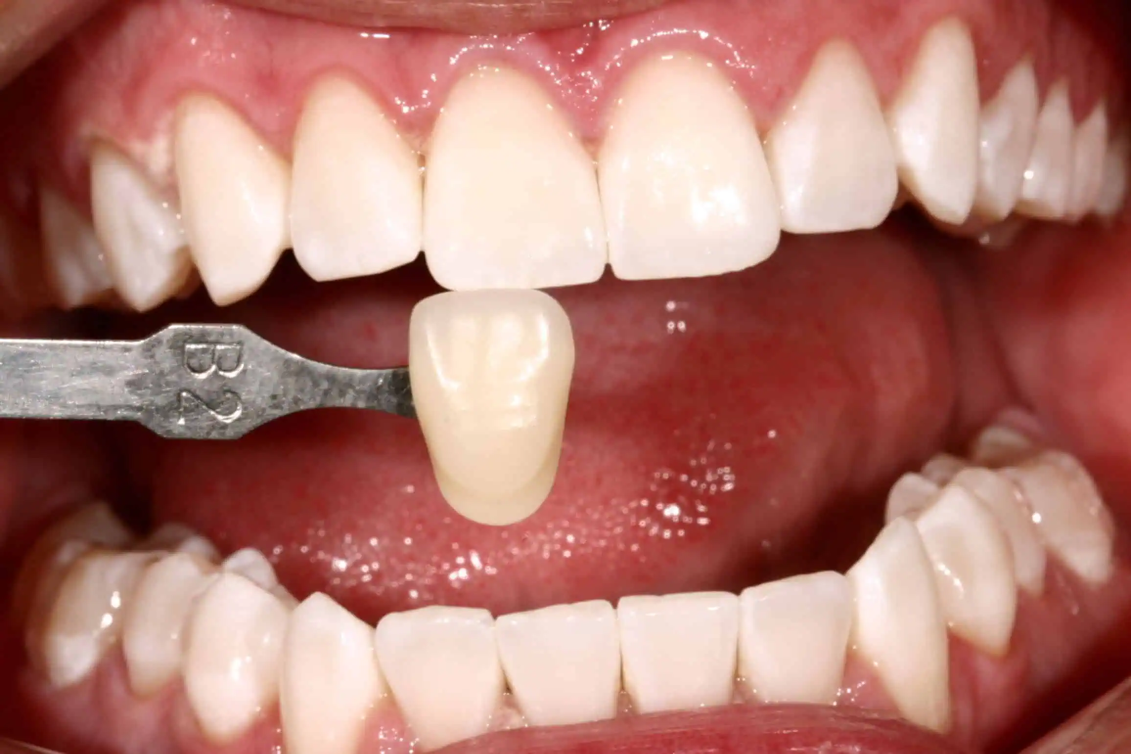 Crown shade test on front tooth in Phoenix, AZ | 24th Street Dental Biltmore