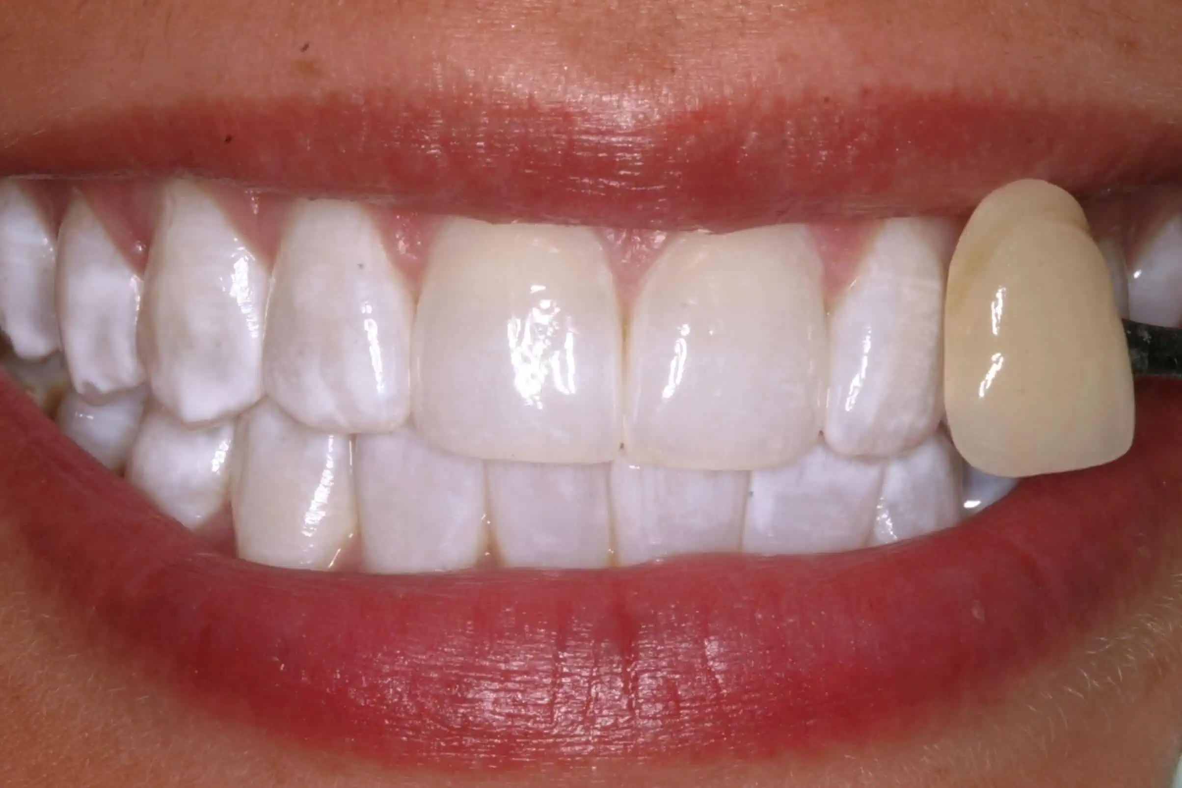 Close-up of teeth after treatment in Phoenix, AZ | 24th Street Dental Biltmore