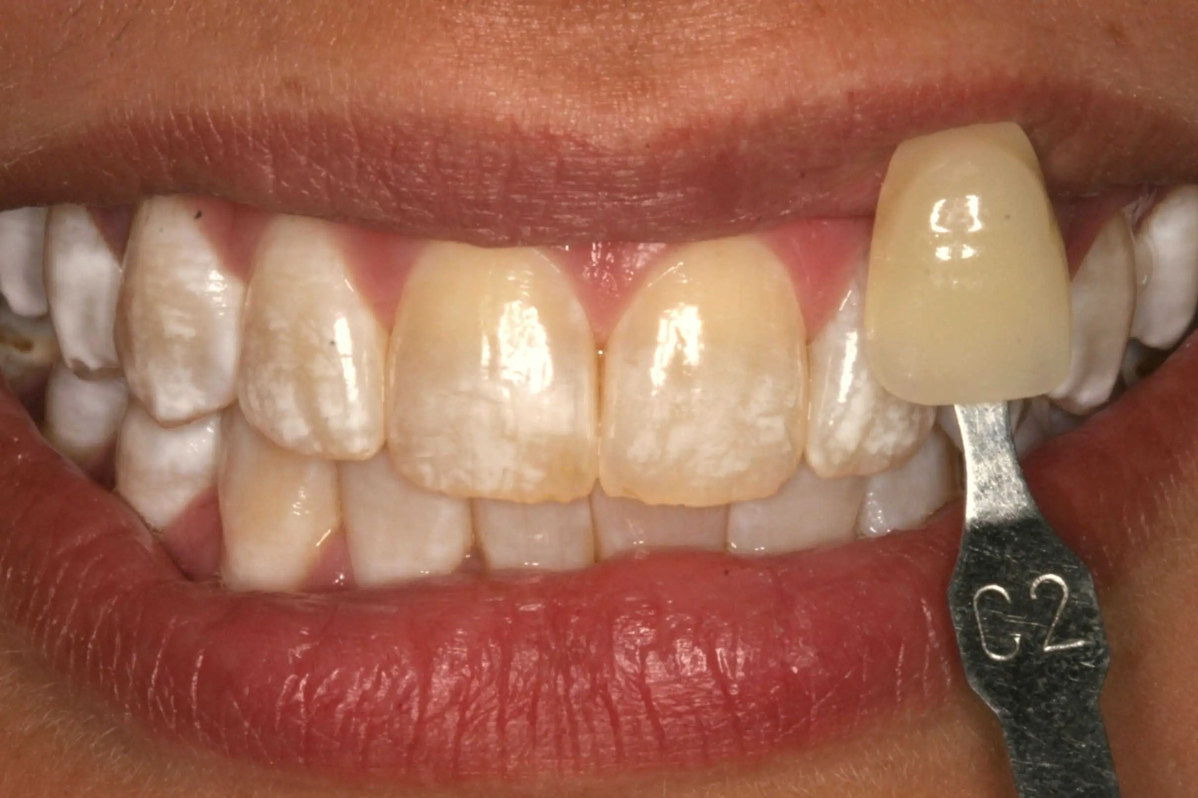 Close-up of teeth before treatment in Phoenix, AZ | 24th Street Dental Biltmore