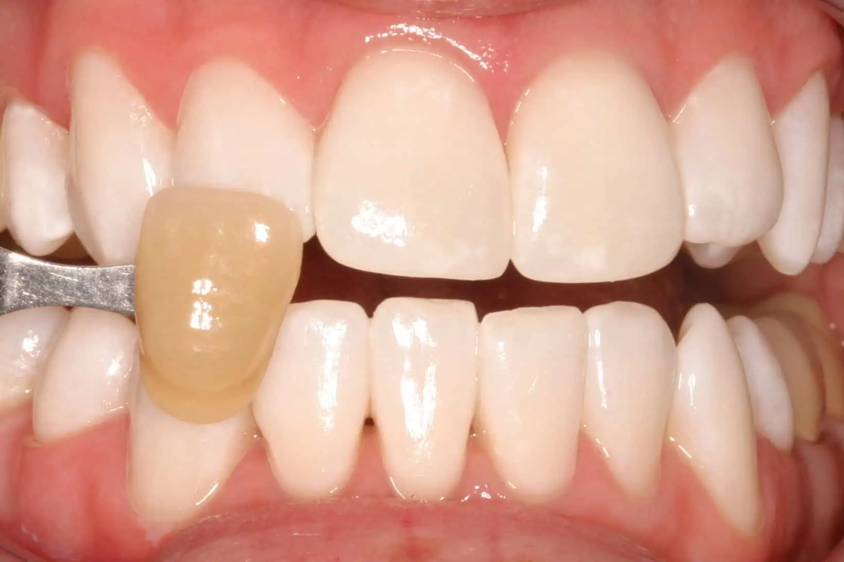 Tooth shade match after crown in Phoenix, AZ | 24th Street Dental Biltmore