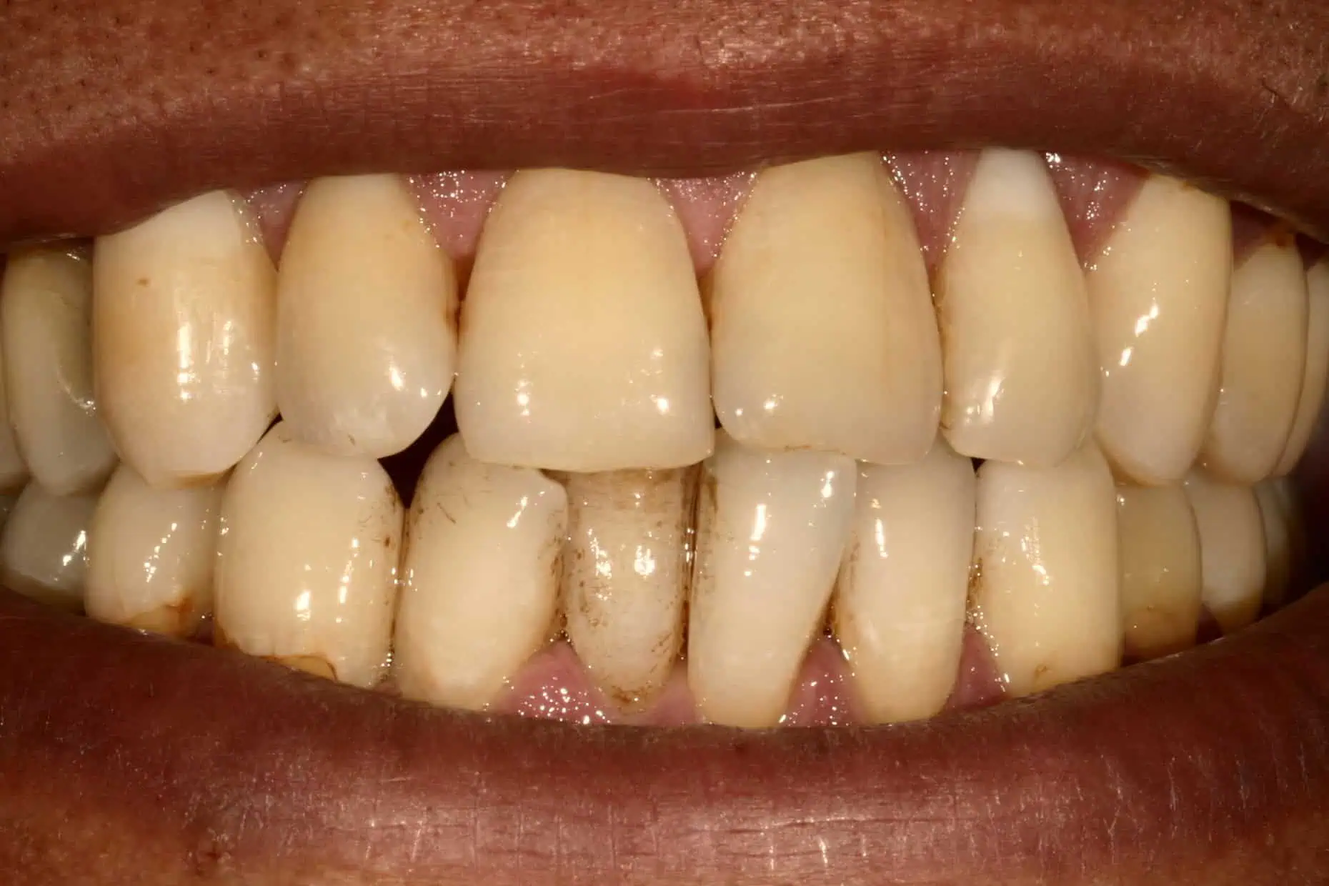 Close-up of teeth before treatment in Phoenix, AZ | 24th Street Dental Biltmore