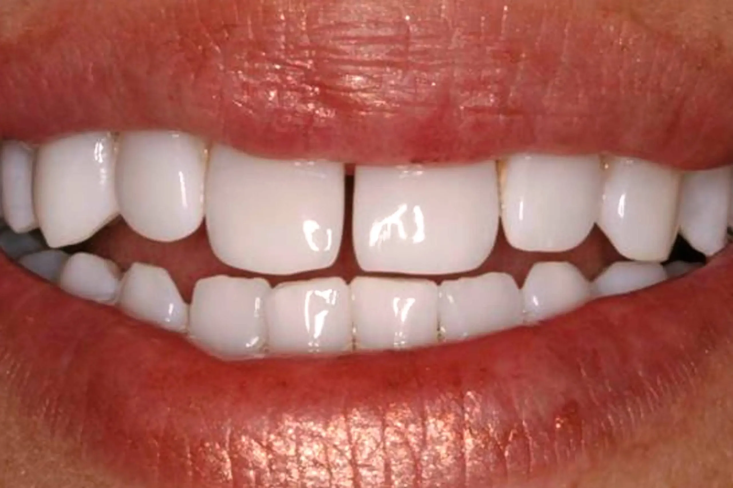 Close-up of teeth after treatment in Phoenix, AZ | 24th Street Dental Biltmore