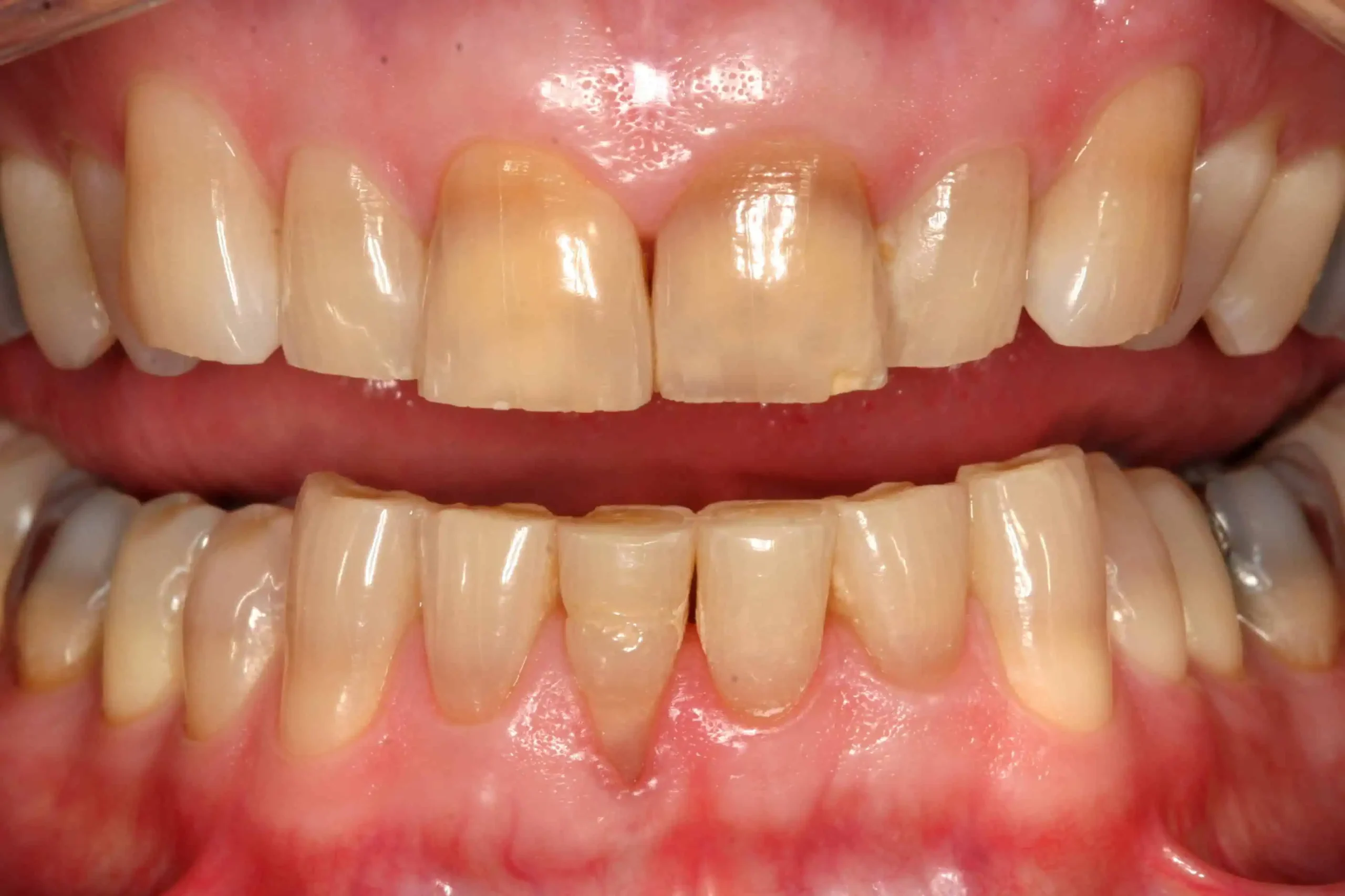 Close-up of teeth before treatment in Phoenix, AZ | 24th Street Dental Biltmore