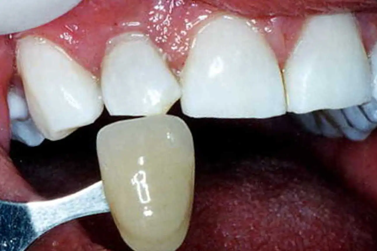 Tooth shade match after crown in Phoenix, AZ | 24th Street Dental Biltmore