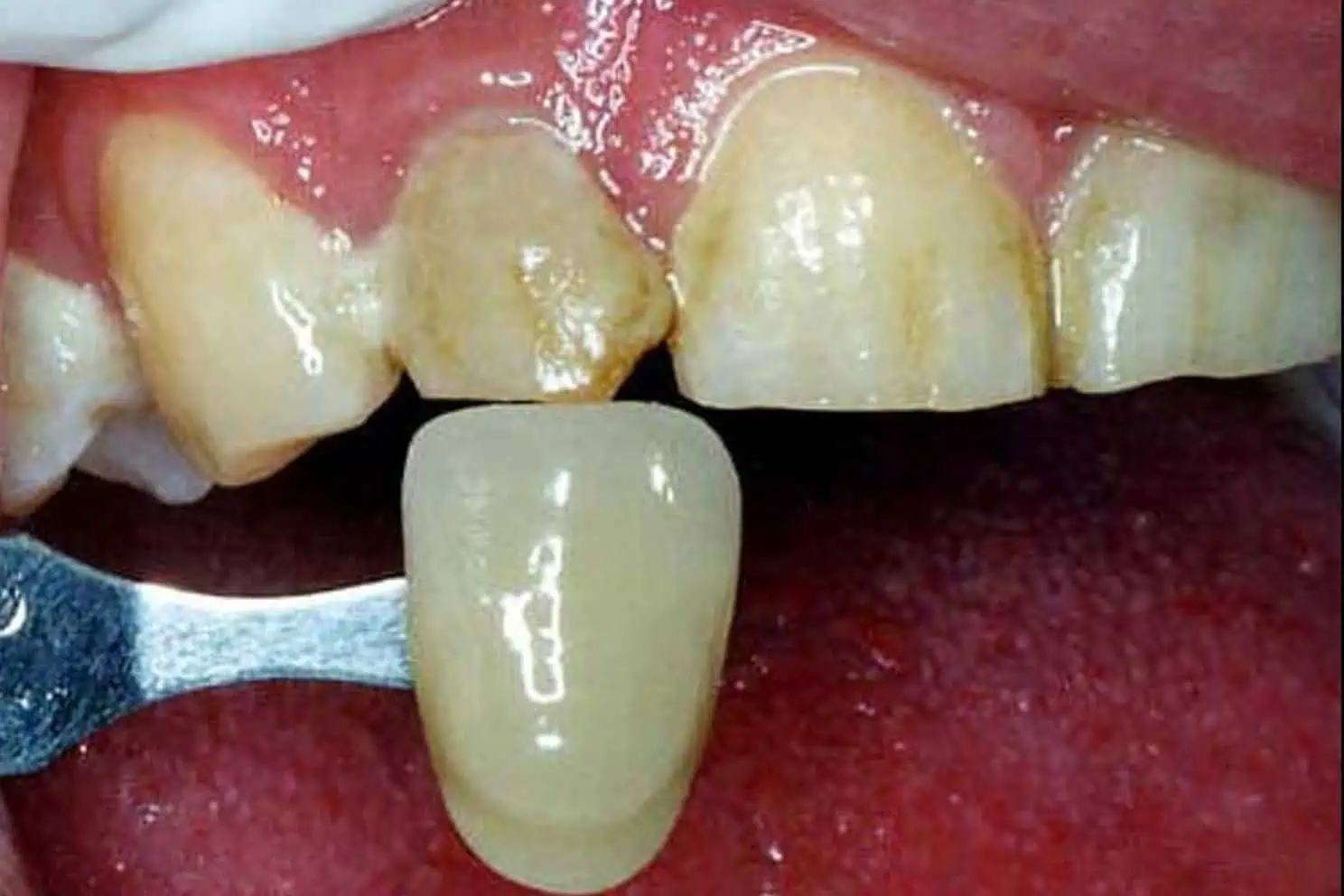 Tooth shade match before crown in Phoenix, AZ | 24th Street Dental Biltmore