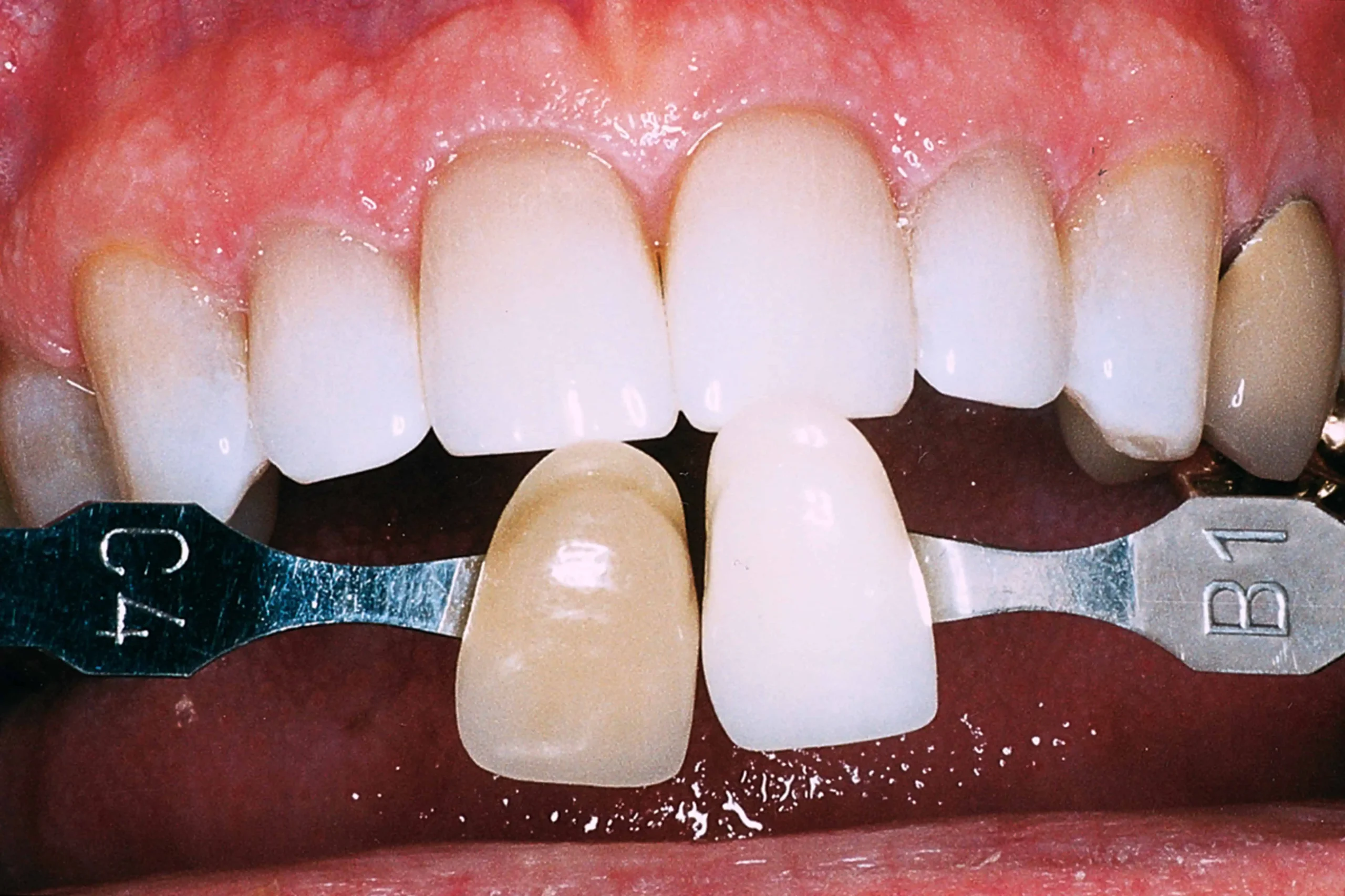 Tooth shade match after crown in Phoenix, AZ | 24th Street Dental Biltmore