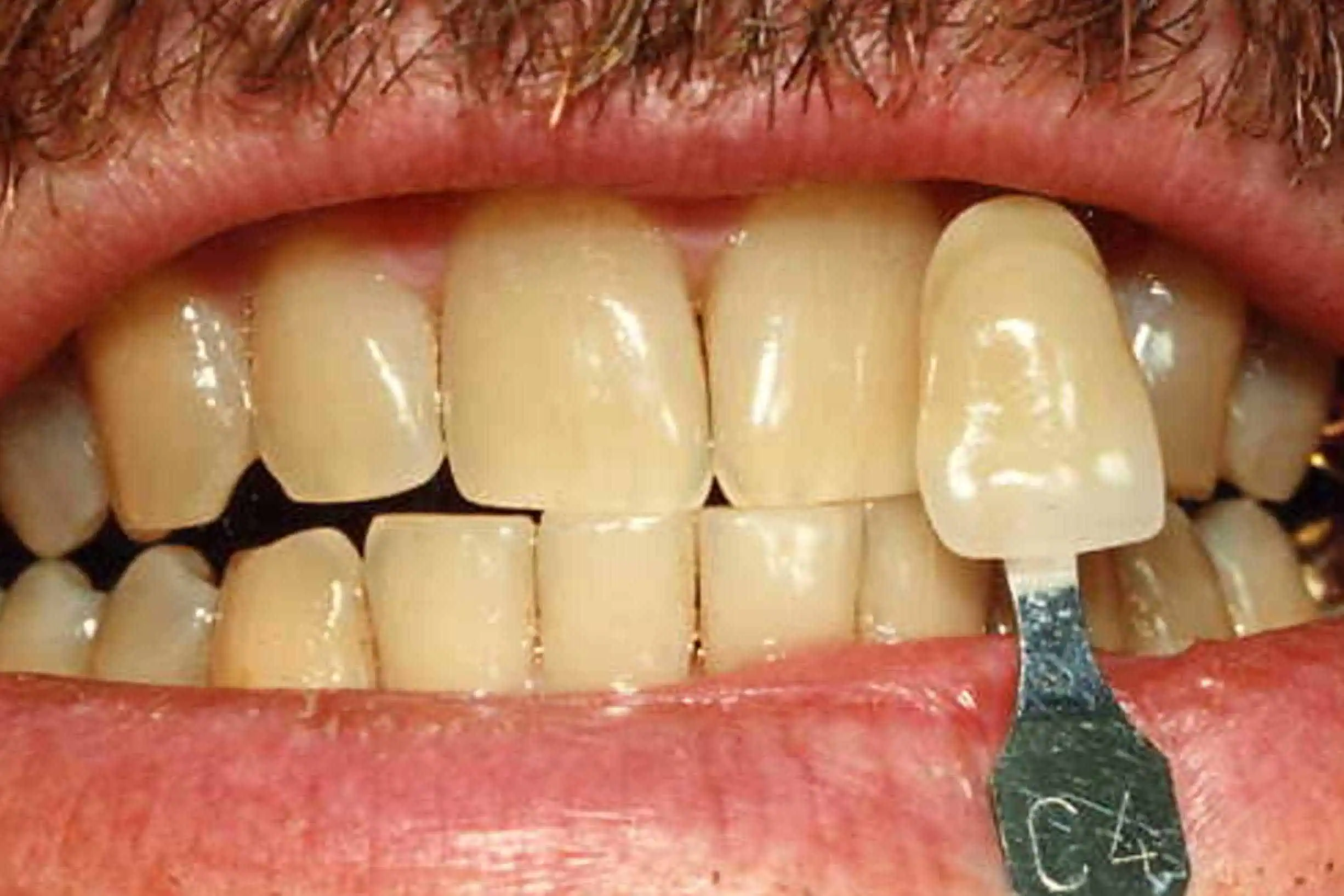 Tooth shade match before crown in Phoenix, AZ | 24th Street Dental Biltmore