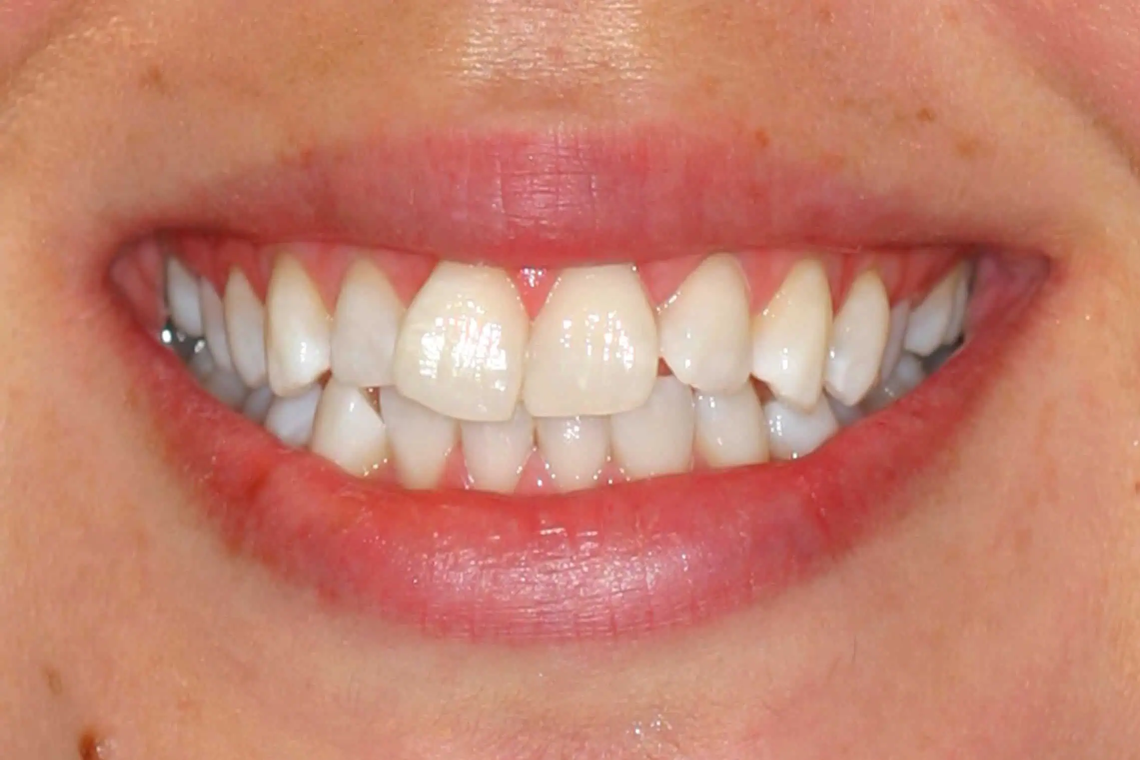 Close-up of teeth after treatment in Phoenix, AZ | 24th Street Dental Biltmore