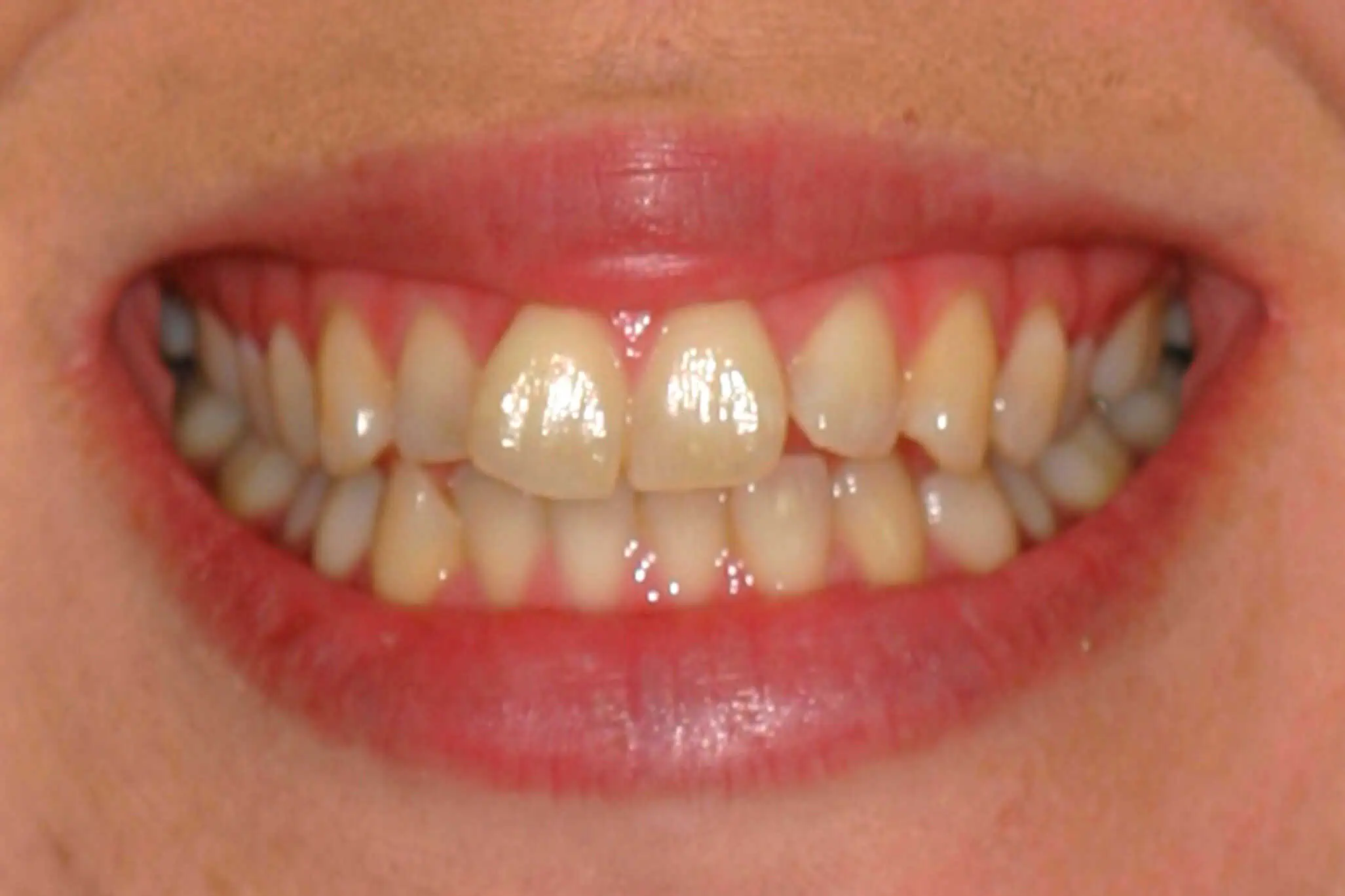 Close-up of teeth before treatment in Phoenix, AZ | 24th Street Dental Biltmore
