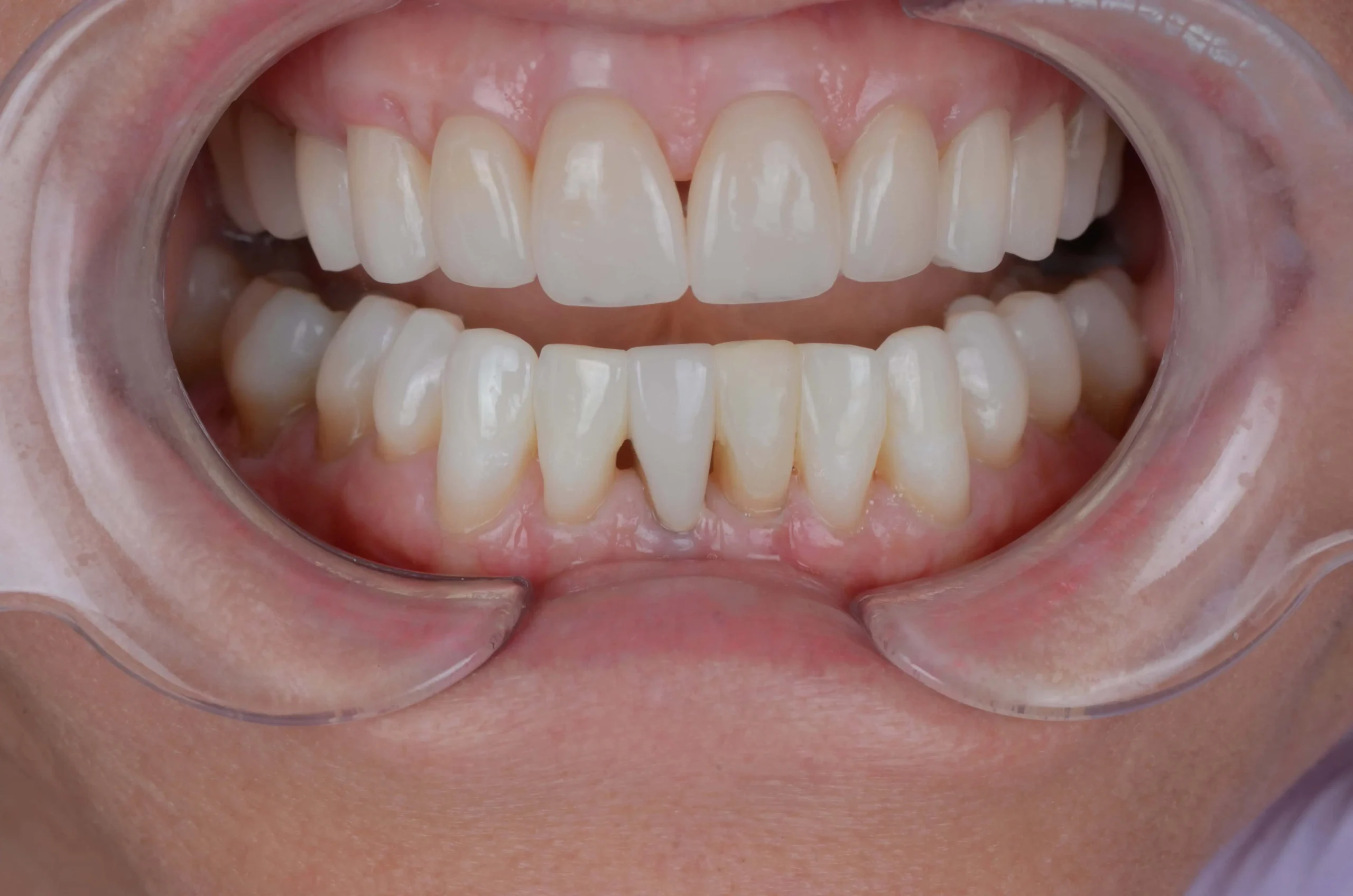 Teeth treatment images showcasing dental health improvement in Phoenix, AZ | 24th Street Dental Biltmore