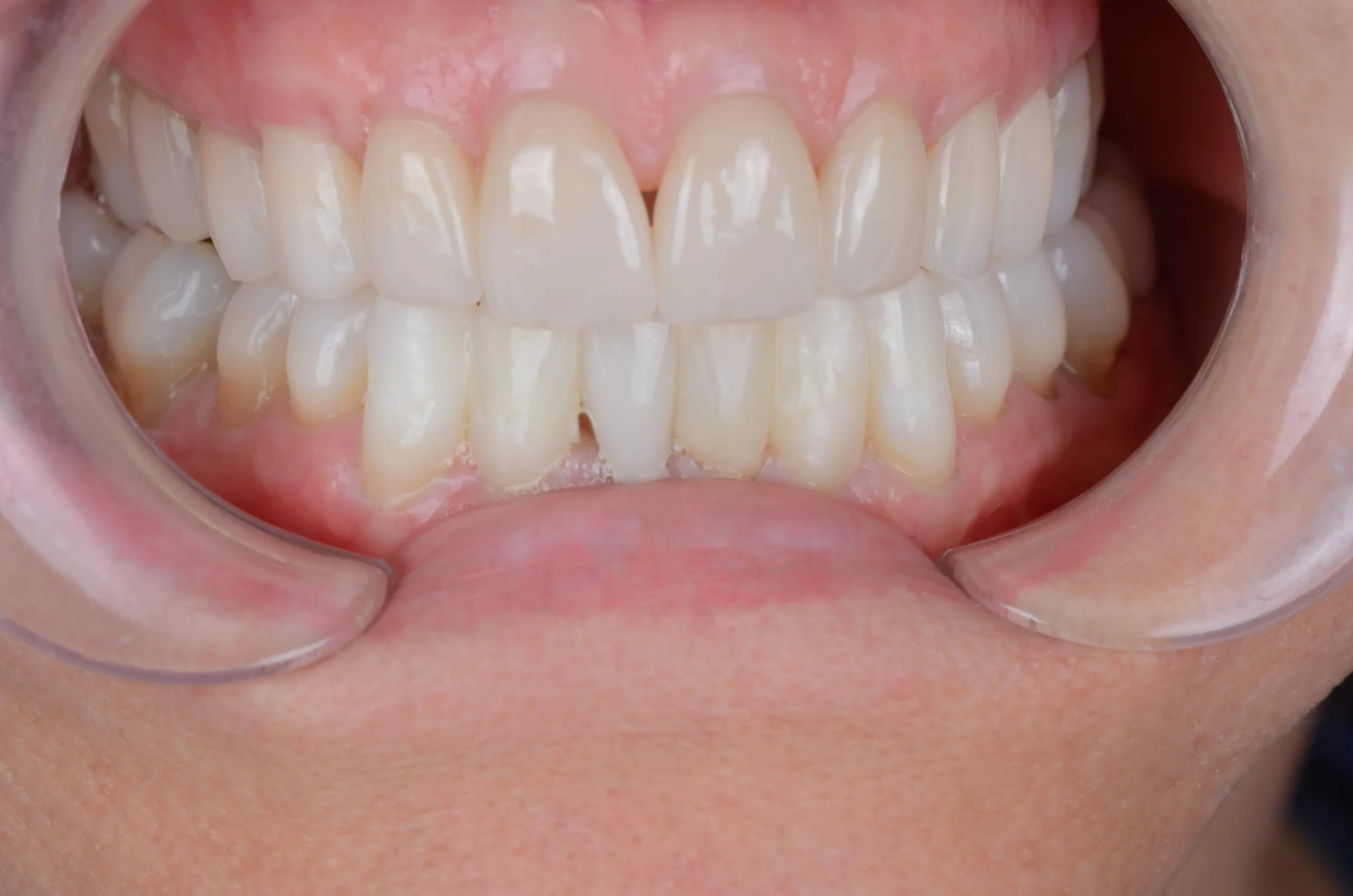 Teeth treatment images showcasing dental health improvement in Phoenix, AZ | 24th Street Dental Biltmore