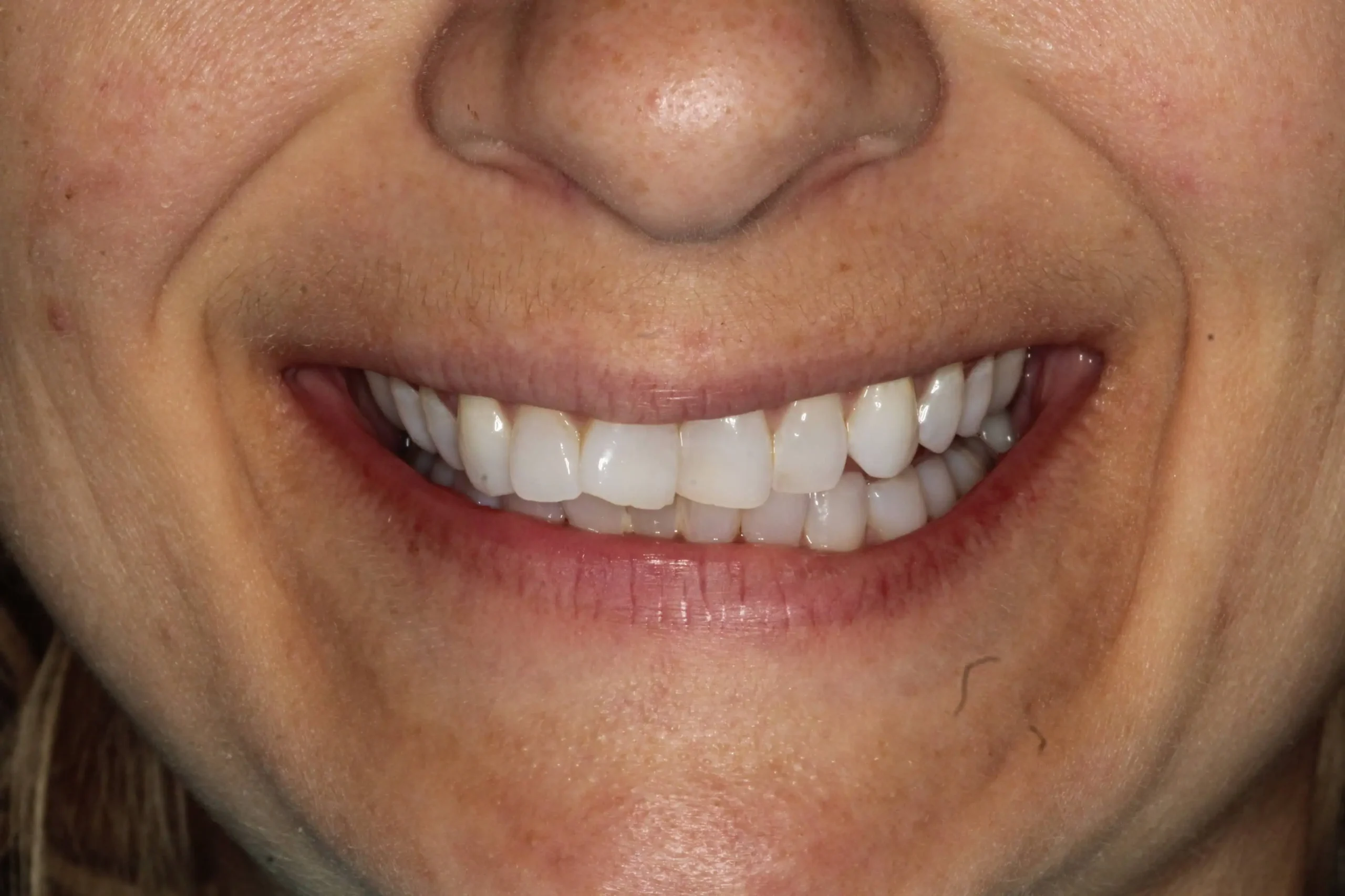 Close-up of teeth after treatment in Phoenix, AZ | 24th Street Dental Biltmore