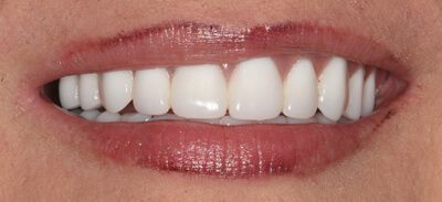 Close-up of teeth after treatment in Phoenix, AZ | 24th Street Dental Biltmore