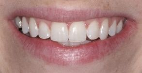 Close-up of teeth after treatment in Phoenix, AZ | 24th Street Dental Biltmore