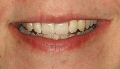 Close-up of teeth after treatment in Phoenix, AZ | 24th Street Dental Biltmore