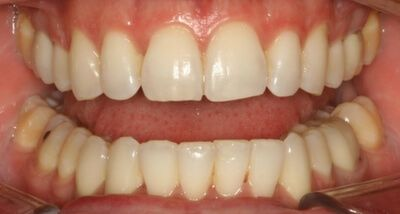 Close-up of teeth after treatment in Phoenix, AZ | 24th Street Dental Biltmore