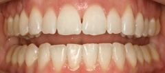 Close-up of teeth dental treatment in Phoenix, AZ | 24th Street Dental Biltmore