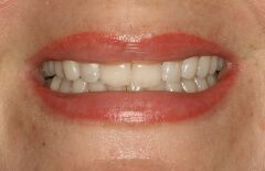 Close-up of teeth dental treatment in Phoenix, AZ | 24th Street Dental Biltmore