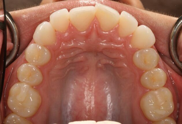 Close-up of teeth before treatment in Phoenix, AZ | 24th Street Dental Biltmore