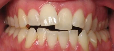 Close-up of teeth before treatment in Phoenix, AZ | 24th Street Dental Biltmore