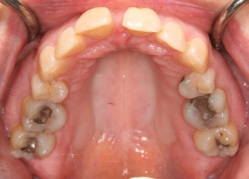 Close-up of teeth dental treatment in Phoenix, AZ | 24th Street Dental Biltmore