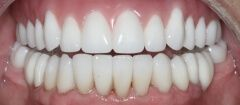 Close-up of teeth after treatment in Phoenix, AZ | 24th Street Dental Biltmore