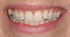 Close-up of teeth before treatment in Phoenix, AZ | 24th Street Dental Biltmore