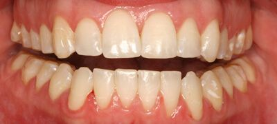 Close-up of teeth after treatment in Phoenix, AZ | 24th Street Dental Biltmore