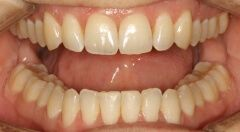 Close-up of teeth after treatment in Phoenix, AZ | 24th Street Dental Biltmore