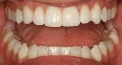 Close-up of teeth dental treatment in Phoenix, AZ | 24th Street Dental Biltmore
