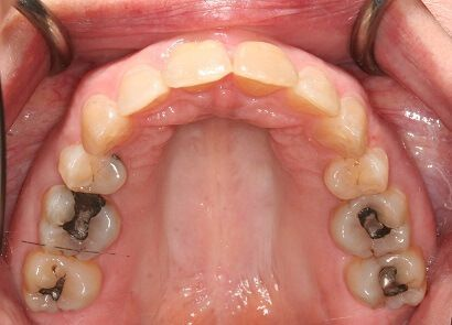 Close-up of teeth dental treatment in Phoenix, AZ | 24th Street Dental Biltmore